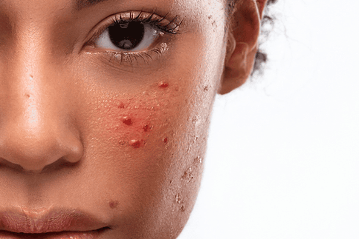 Acne Products Acne Products