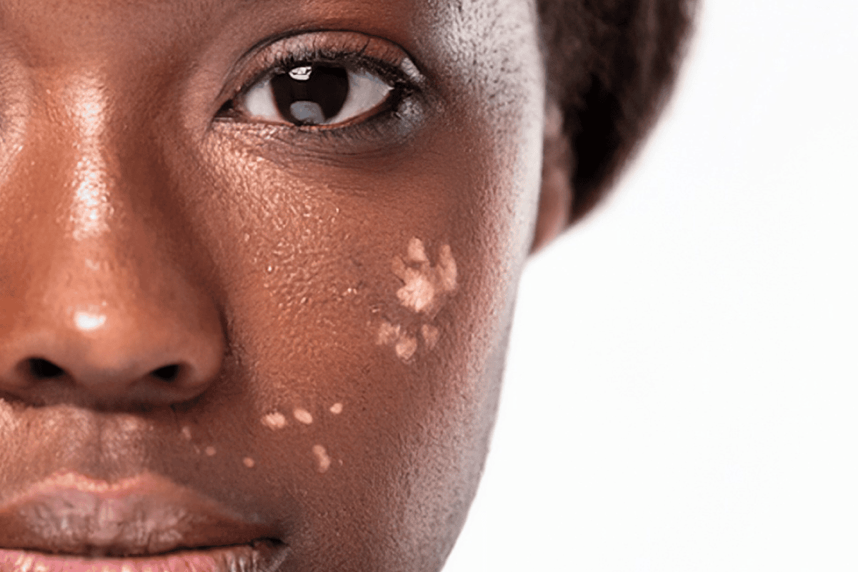 Hyperpigmentation