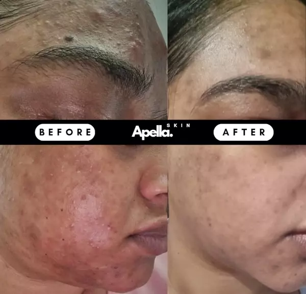 Skincare results of a customer's face from Apella Skins products. Skincare results of a customer's face from Apella Skins products.