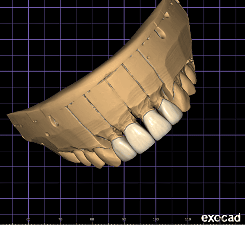 Veneers