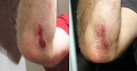 Watch the wound heal through the dressing.