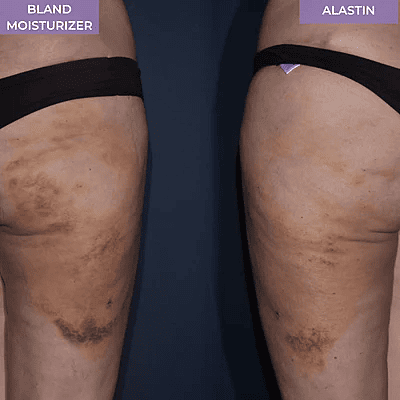 ALASTIN ReFORM & RePAIR