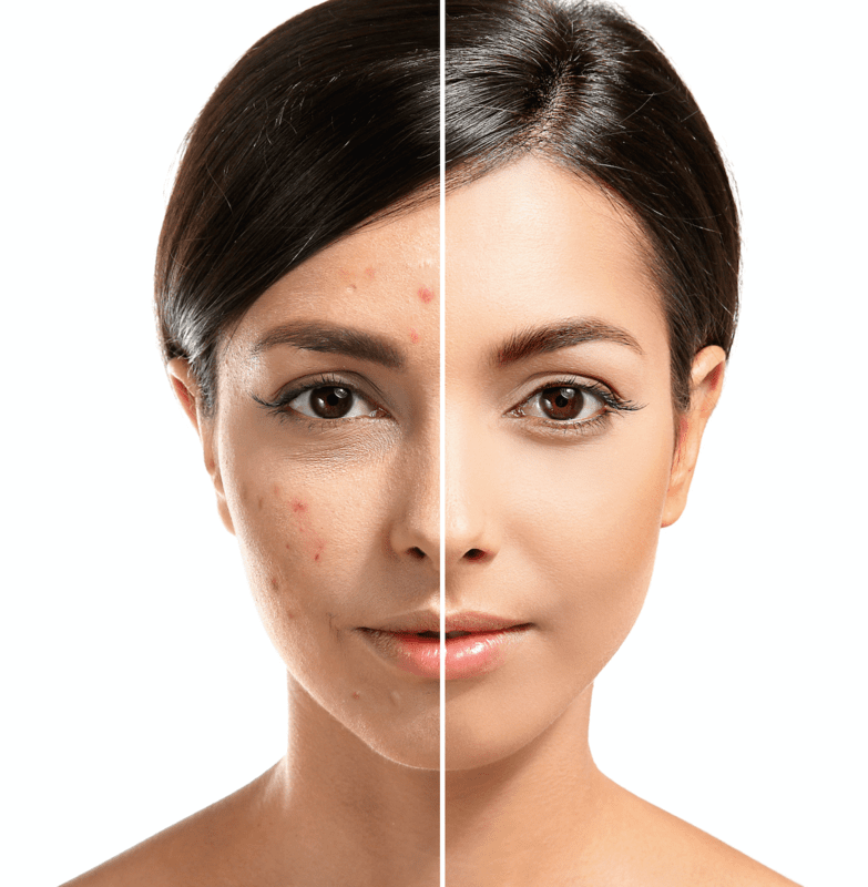 High Frequency Treatment (15 min)