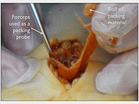Forceps used as a packing probe with a roll of backing material.